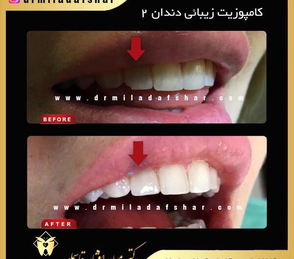 عکس کامپوزیت دندان طرح لبخند