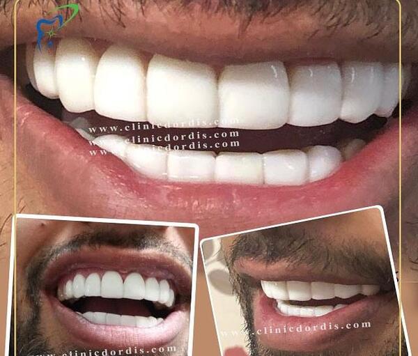 عکس کامپوزیت دندان طرح لبخند