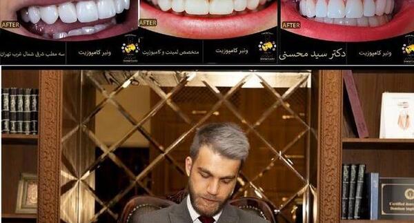 عکس کامپوزیت دندان طرح لبخند