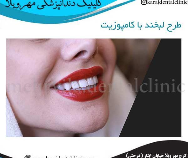 عکس کامپوزیت دندان طرح لبخند