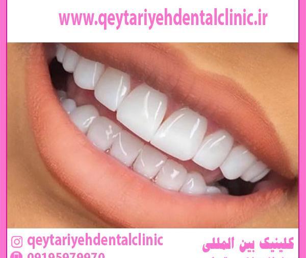 عکس کامپوزیت دندان طرح لبخند