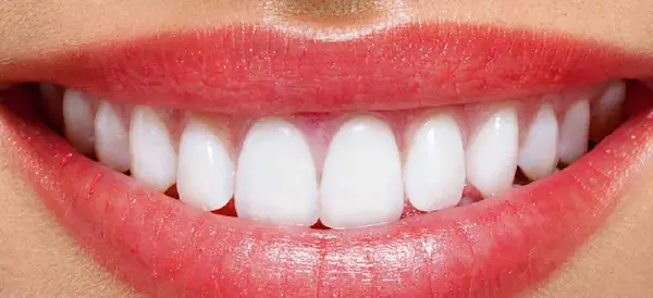 عکس لبخند برای دندانپزشکی