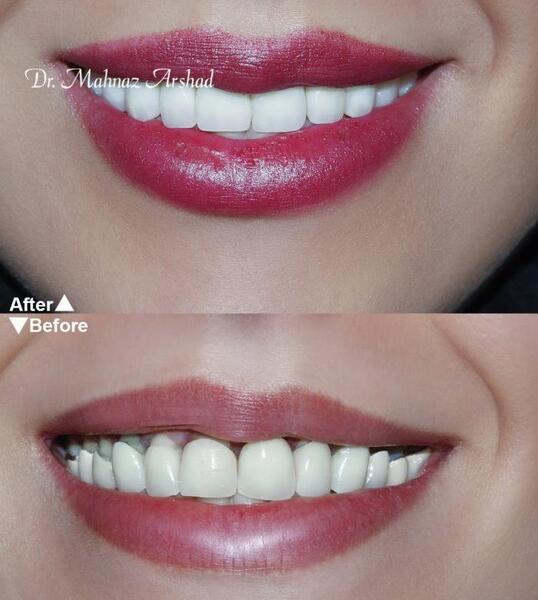 عکس لبخند برای دندانپزشکی