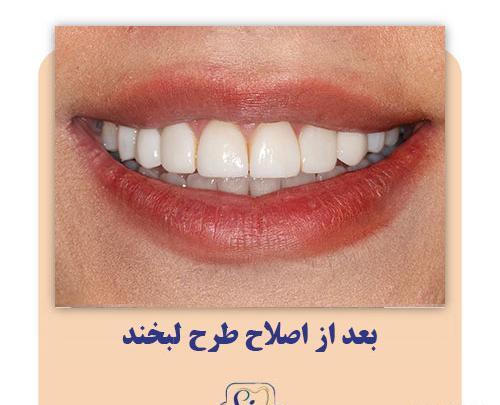 عکس لبخند و دندان