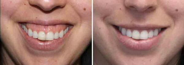 چگونه در عکس لبخند بزنیم