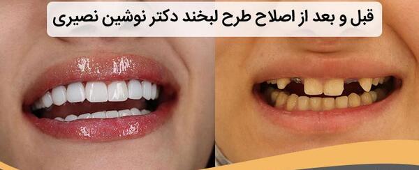 چطوری در عکس لبخند بزنیم