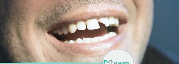 عکس لبخند بچه بی دندون