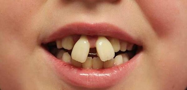 عکس لبخند بچه بی دندون
