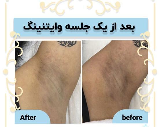 عکس لکه های قهوه ای زیر بغل