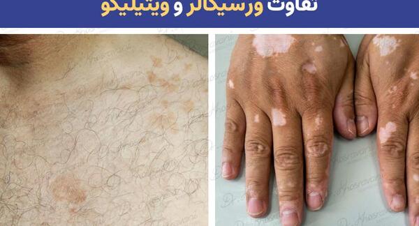 عکس لکه های قهوه ای زیر بغل