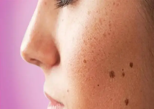 عکس لکه های قهوه ای زیر بغل نی نی سایت