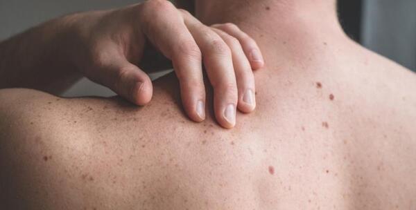 عکس لکه های قهوه ای زیر بغل نی نی سایت