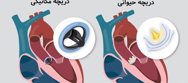 عکس دریچه قلب مصنوعی