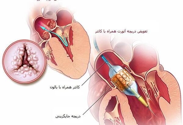 عکس دریچه قلب مصنوعی