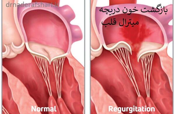 عکس دریچه قلب مصنوعی