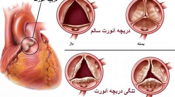 عکس دریچه قلب مصنوعی