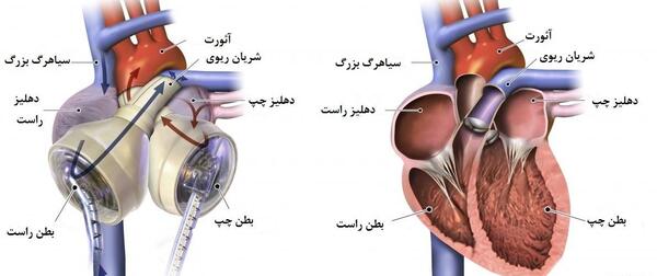 عکس دریچه قلب مصنوعی