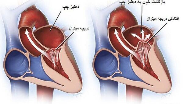عکس دریچه قلب مصنوعی