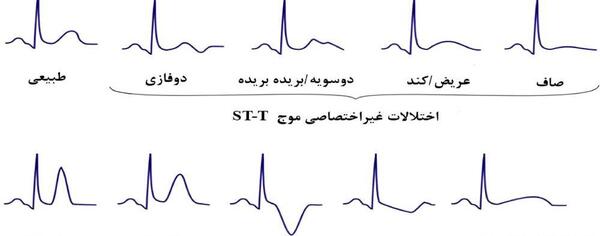 عکس نوار قلب سکته قلبی