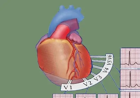 عکس نوار قلب ضعیف