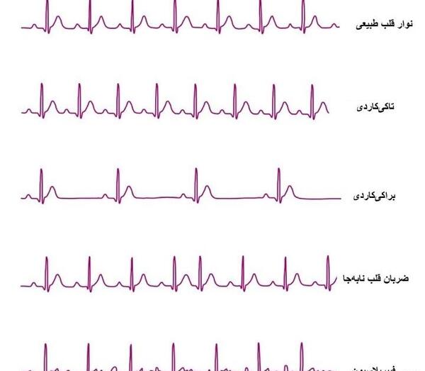 عکس نوار قلب ضعیف