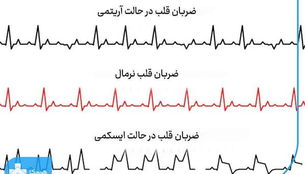 طبیعی عکس نوار قلب سالم