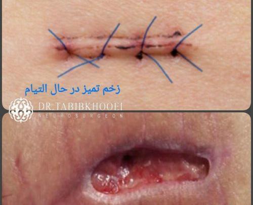 عکس قلب چسب زخم خورده