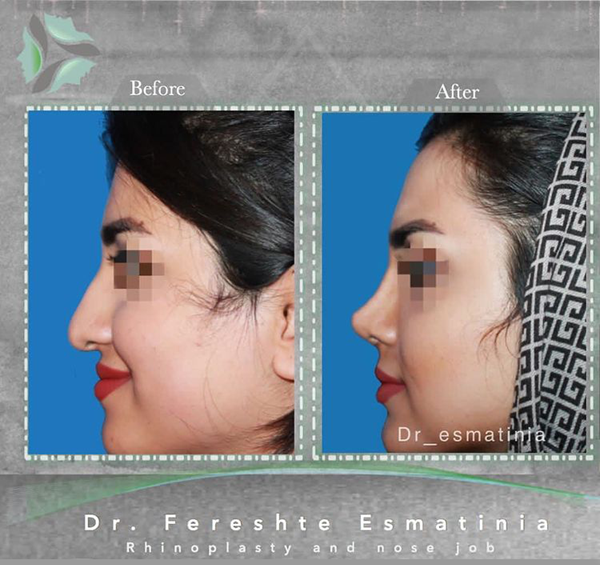 عکس بینی نیمه فانتزی نی نی سایت