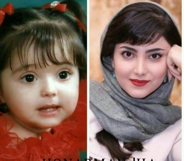 عکس زیبا کرمعلی قبل از عمل بینی
