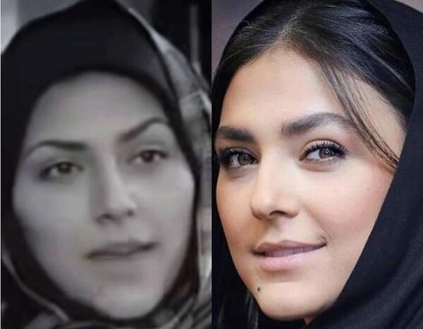 عکس زیبا کرمعلی قبل از عمل بینی