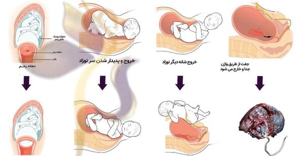 عکس زایمان طبیعی از روبرو لحظه خروج نوزاد