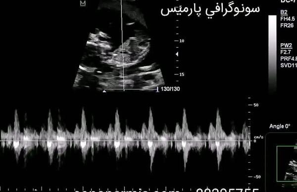 هفته عکس ضربان قلب جنین پسر