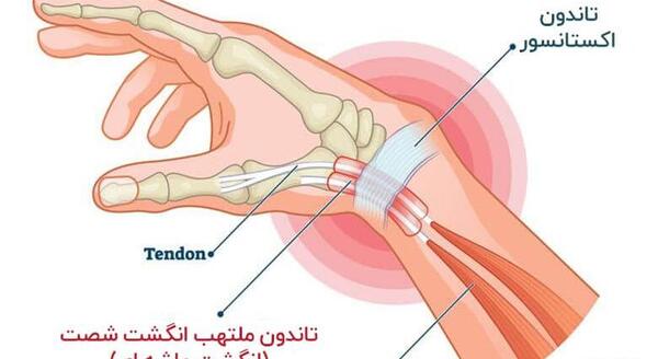 عکس شاهرگ زدن دست