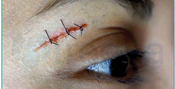عکس شاهرگ و تیغ زخم عمیق
