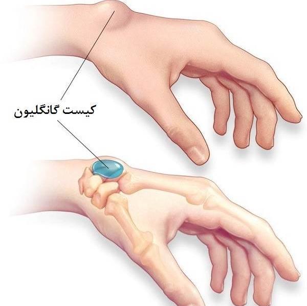 عکس شاهرگ اصلی دست کجاست