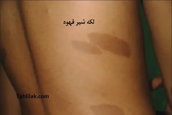 عکس لکه های شیر قهوه