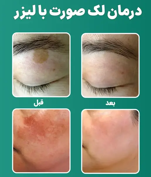 عکس لکه های شیر قهوه