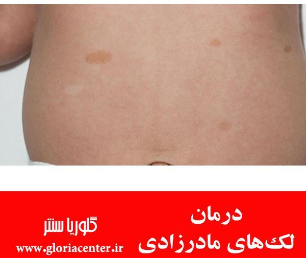 عکس لکه های شیر قهوه