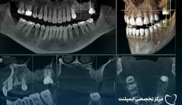 عکس سه بعدی دندان عقل