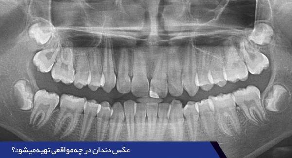 عکس سه بعدی دندان عقل