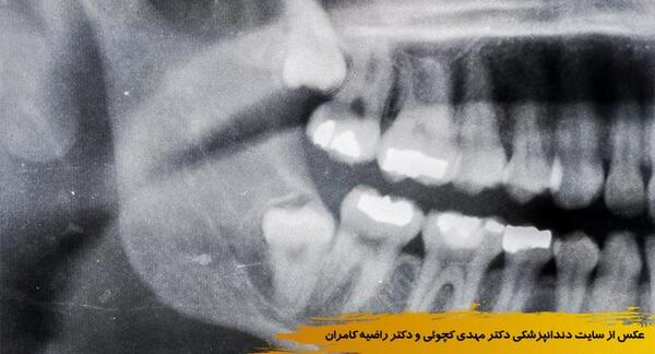 عکس سه بعدی دندان عقل