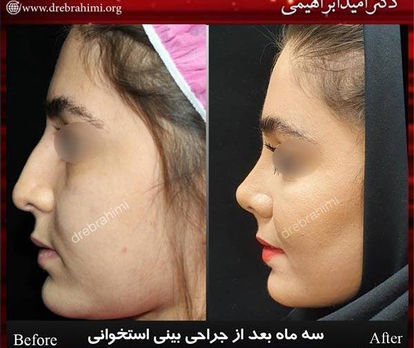 عکس سه بعدی قبل از عمل بینی