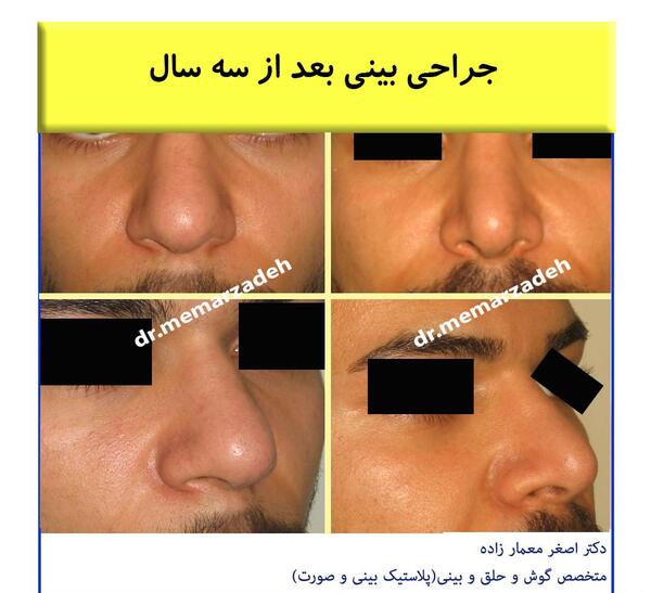 عکس سه بعدی قبل از عمل بینی