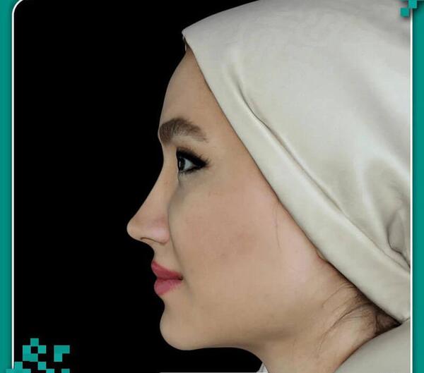 عکس سه بعدی قبل از عمل بینی