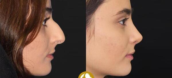عکس سه بعدی قبل از عمل بینی