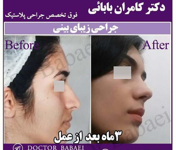 عکس سه بعدی قبل از عمل بینی