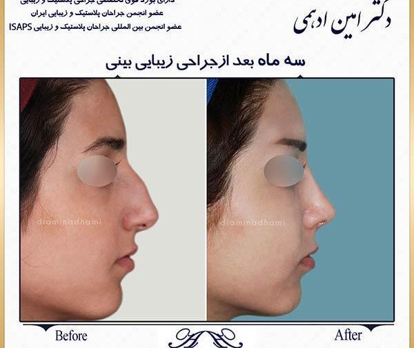 عکس سه بعدی قبل از عمل بینی