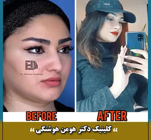 عکس سه بعدی قبل از عمل بینی