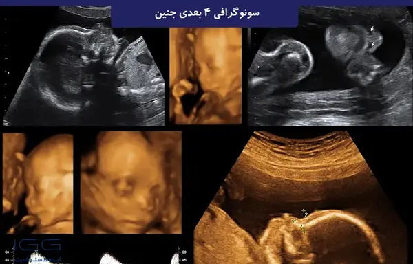 عکس سونوگرافی سه بعدی جنین