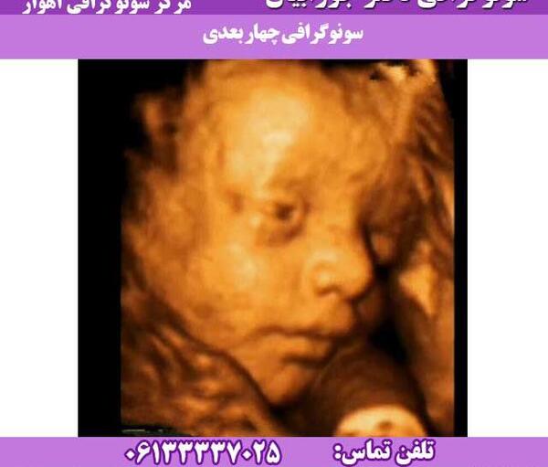 عکس سونوگرافی سه بعدی جنین